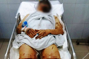 Nhận dạng nghi phạm tạt axit, cắt đứt gân chân nam Việt kiều: Người gầy, nói giọng Bắc