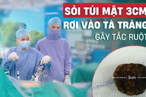 Hi hữu: Sỏi mật 3cm rơi từ túi mật vào tá tràng gây tắc ruột