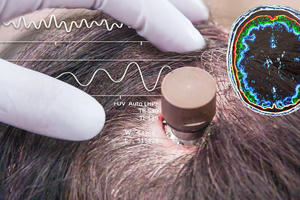 Người đàn ông bị liệt chỉnh sửa video, đăng YouTube 'chỉ bằng suy nghĩ': Ca cấy chip não Neuralink thứ ba gây chấn động