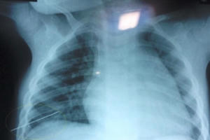 TP HCM: Bệnh viện Chợ Rẫy cứu sống nạn nhân bị đâm thủng ngực