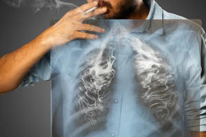 Năm 2020, hơn 23.000 ca tử vong do ung thư phổi Năm 2020, hơn 23.000 ca tử vong do ung thư phổi