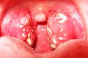 Ổ dịch bạch hầu bùng phát tại Quảng Nam khiến hai học sinh tử vong