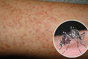 TP. HCM thêm 3 ca tử vong do sốt xuất huyết