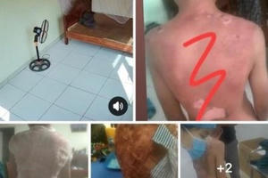 Vĩnh Phúc: Công an điều tra vụ bé trai bị bỏng nặng nghi do mẹ kế dội nước sôi