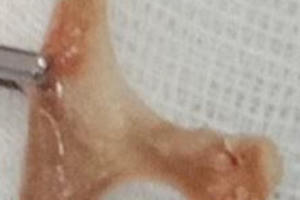 Nội soi gắp mảnh xương vịt 3 cm sắc nhọn cắm vào thực quản nam bệnh nhân