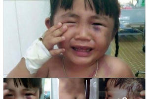 Cha dượng đã bạo hành bé gái 3 tuổi dã man như thế nào?