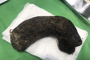 Hoảng hồn khi phát hiện búi tóc nặng 1kg nằm trong dạ dày bé gái 11 tuổi ở Nghệ An