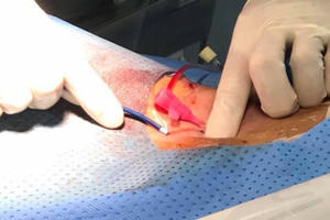 4 bệnh nhi bị tim bẩm sinh được điều trị thành công