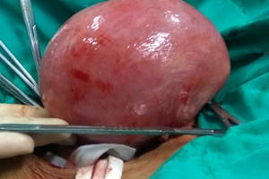 Cắt bỏ thành công khối u “khổng lồ” trong cơ thể người phụ nữ