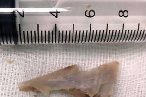 Nội soi phát hiện xương lợn sắc nhọn dài 3 cm mắc kẹt trong cổ họng bé gái 6 tuổi