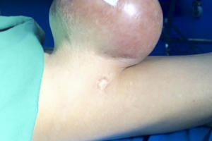 Khối u nặng hơn 2 kg đang hoại tử trên cơ thể bệnh nhân khiến bác sỹ cũng giật mình Khối u nặng hơn 2 kg đang hoại tử trên cơ thể bệnh nhân khiến bác sỹ cũng giật mình