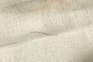 Bé gái bị mắc sợi inox trong thực quản