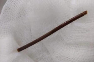 Cụ bà bị đâm thủng dạ dày vì... tăm xỉa răng