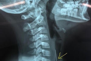 Gắp thành công cây kim dài hơn 4cm trong đường thở bé trai Gắp thành công cây kim dài hơn 4cm trong đường thở bé trai