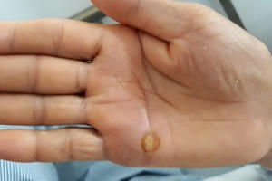 Bị cứng hàm mất cảm giác chân vì… dằm tre cắm vào tay