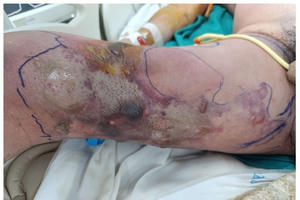 Người đàn ông suýt tử vong vì vết thương nhỏ bị "đốt" khi đi tắm biển