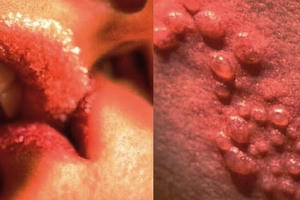 Bệnh viện Da liễu trung ương khám miễn phí các bệnh lây qua đường tình dục