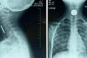 Quảng Nam: Mải vui chơi, bé gái 5 tuổi sơ ý nuốt đồng xu ngậm trong miệng