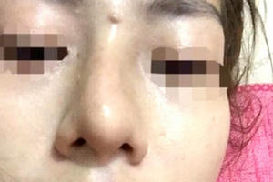 Vụ bé gái 13 tuổi tổn hại 42% sức khỏe khi đi nâng mũi: Khôi phục quyền khiếu nại của gia đình bị hại