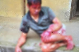 Bắc Giang: Người đàn ông tâm thần bị hàng xóm chém 7 nhát vào đầu