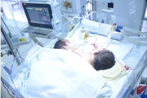 Lời kể xót xa của cha mẹ 2 bé song sinh dính liền ở Hà Giang