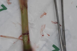 Bé 8 tuổi nhập viện với gốc cỏ voi dài 20cm cắm vào bụng