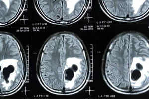 Chụp CT phát hiện 5 ổ sán làm tổ trong não nam bệnh nhân