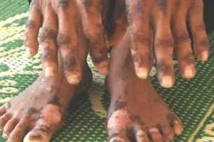 “Bệnh lạ” ở Quảng Ngãi không lạ như đồn đại