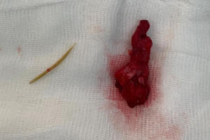 Một bệnh nhân hóc xương cá nằm trong ổ bụng được chữa trị kịp thời