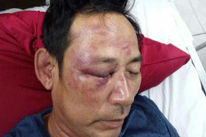 Làm thơ đăng trên Facebook, người đàn ông bị đánh hội đồng thương tích nặng