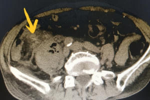 Tăm xỉa răng sắc nhọn đâm thủng ruột cụ ông