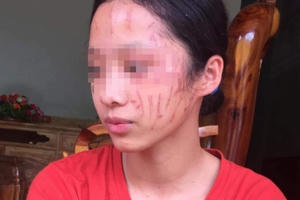 Ám ảnh khuôn mặt nữ sinh lớp 8 bị bạn cào xước Ám ảnh khuôn mặt nữ sinh lớp 8 bị bạn cào xước