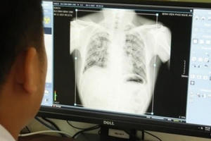 Thêm 57 người từng làm tại Công ty Châu Tiến mắc bệnh do bụi phổi