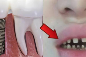 Nguy cơ tiềm ẩn đằng sau trào lưu răng sứ