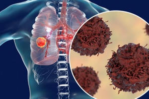 Dấu hiệu "đáng ngạc nhiên" này ở lưng cảnh báo ung thư phổi