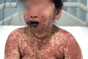 Dị ứng thuốc, bé 7 tuổi bị bỏng toàn thân