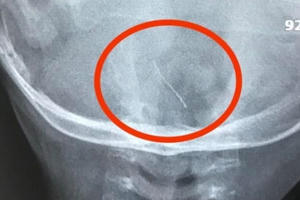 Con nôn ra máu, mẹ phát hoảng đưa đến bệnh viện mới biết “hung thủ” là sợi thép dài 2cm