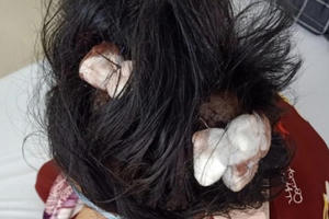 Điều tra vụ việc bé gái 16 tuổi bị cha dượng đánh dập lá lách, gãy xương sườn