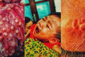 "Hé lộ" sự thật về căn bệnh ấu trùng sán bạn nên biết