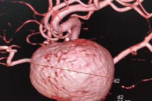 "Làm sạch" mạch máu: Coi chừng tiền mất tật mang