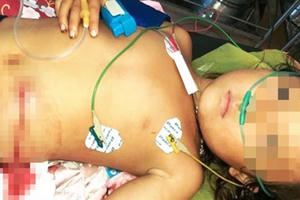 Cháu gái bị máy cắt cỏ chém lòi ruột, ông nội tự lấy kim chỉ khâu lại