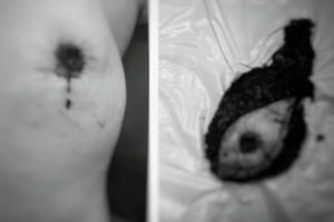 Mất núm vú vì chữa ung thư bằng thuốc Nam