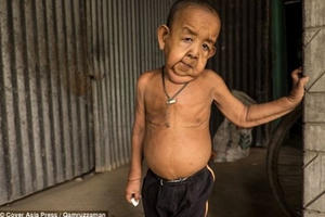 Cậu bé 4 tuổi mang ngoại hình ông lão 80 vì mắc bệnh lạ