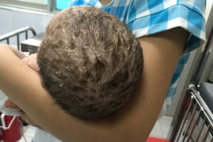 Chữa thủy đậu bằng tắm lá, bé trai phải nhập viện Chữa thủy đậu bằng tắm lá, bé trai phải nhập viện