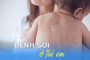 Hà Nội: Số ca sởi, chân tay miệng tiếp tục gia tăng