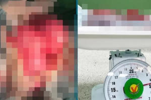 'Sợ dao kéo', người phụ nữ để khối u nặng gần 5kg, chèn lên nội tạng