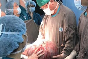Mang khối u buồng trứng nặng 20kg, người phụ nữ 29 tuổi không thể đi lại