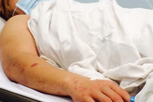 Viêm não mô cầu: Người dân cần chủ động phòng tránh