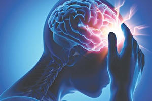 Cảnh báo nguy cơ đột quỵ vào những ngày thời tiết nắng nóng đỉnh điểm và cách phòng tránh