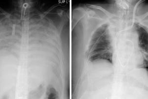 Trường hợp hy hữu nhiễm Covid-19 được ghép phổi từ người hiến tặng còn sống